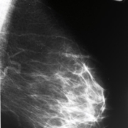 ASCO-2019-breast-cancer-TNBC-MBC-ABC-ASCO19-MONALEESA-7-TRINITI-1-FAKTION-TBCRC030-NeoSTOP-ETNA-GeparOLA-KRISTINE-PREDIX-CLEOPATRA-HERITAGE-SOPHIA-NALA-IMpassion-130