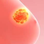Capivasertib-added-to-fulvestrant-improves-progression-free-survival-in-advanced-breast-cancer-patients