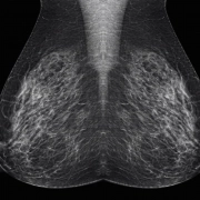 Abemaciclib-A-review-of-the-evidence-through-clinical-case